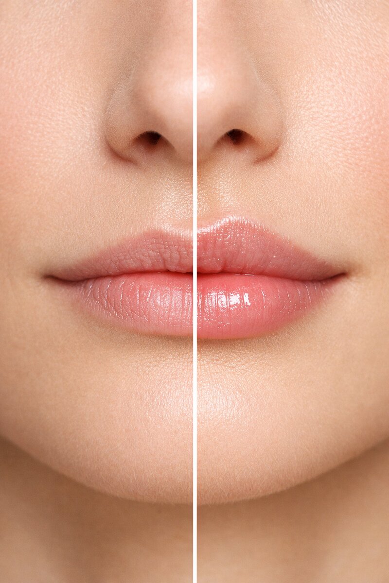 Preenchimento Labial