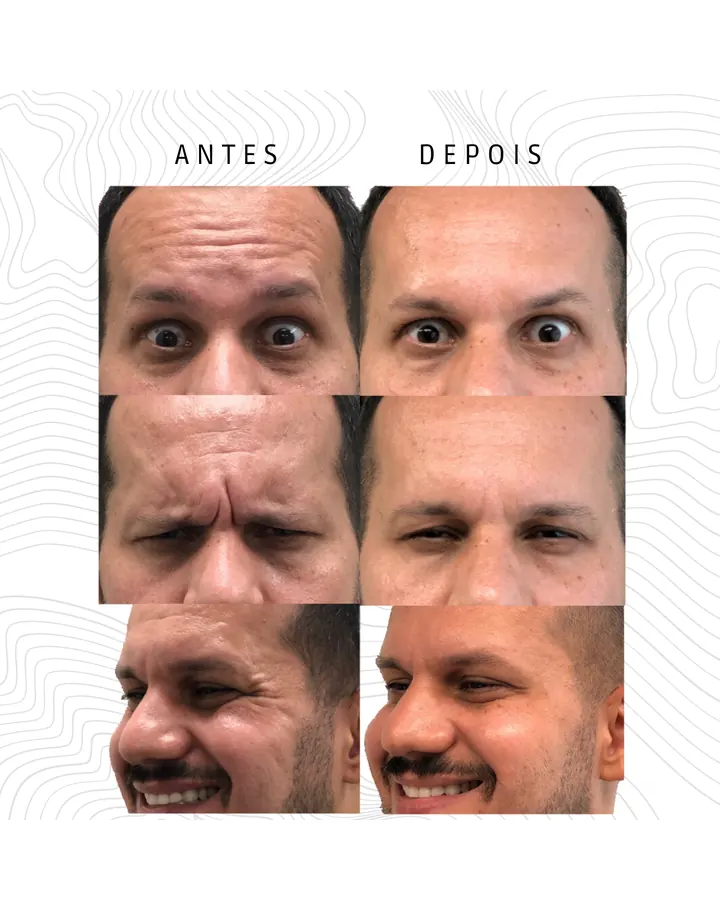 Toxina Botulínica — paciente 1