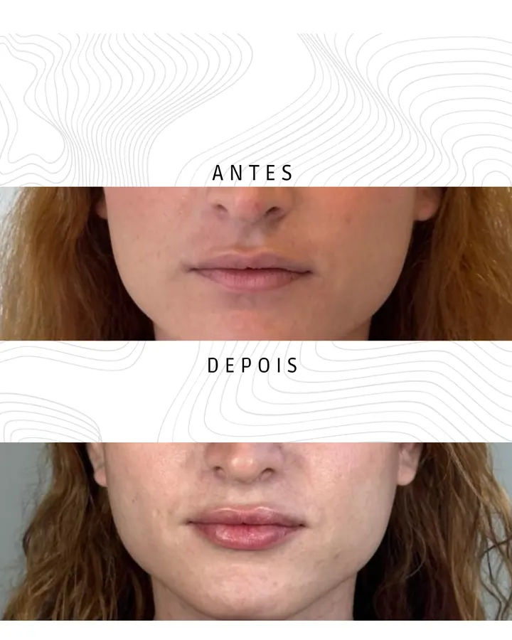 Toxina Botulínica — paciente 2