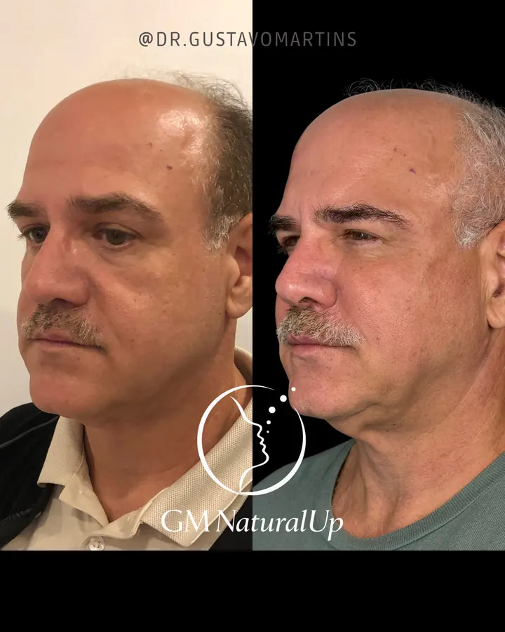 Método NaturalUp® — paciente 3