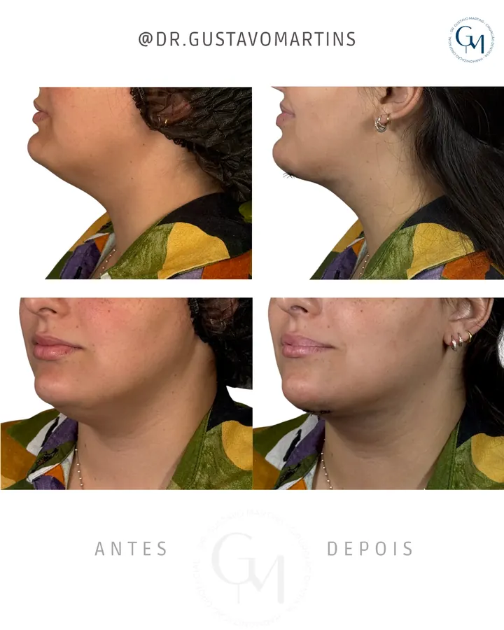 Método NaturalUp® — paciente 12