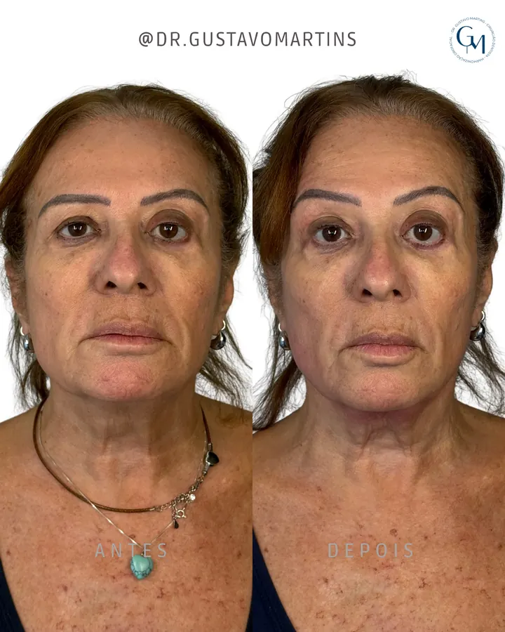 Método NaturalUp® — paciente 15