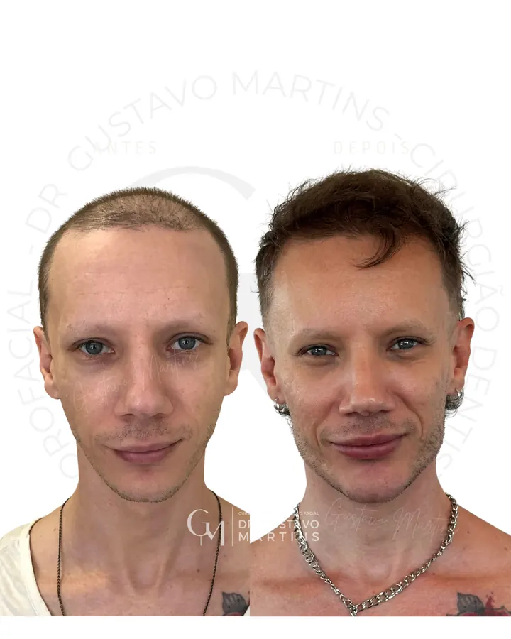 Método NaturalUp® — paciente 20