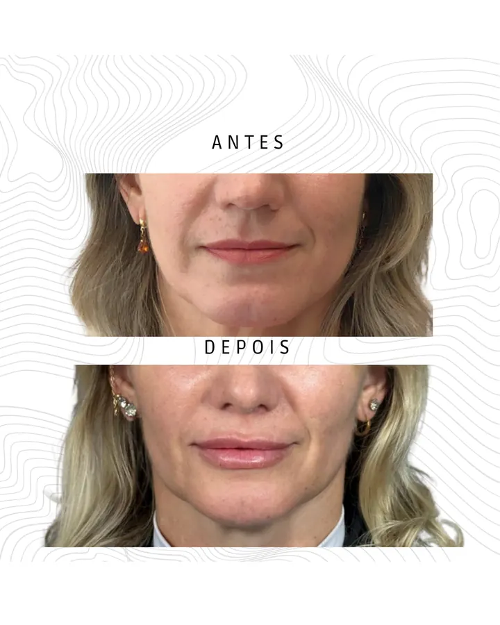 Método NaturalUp® — paciente 26