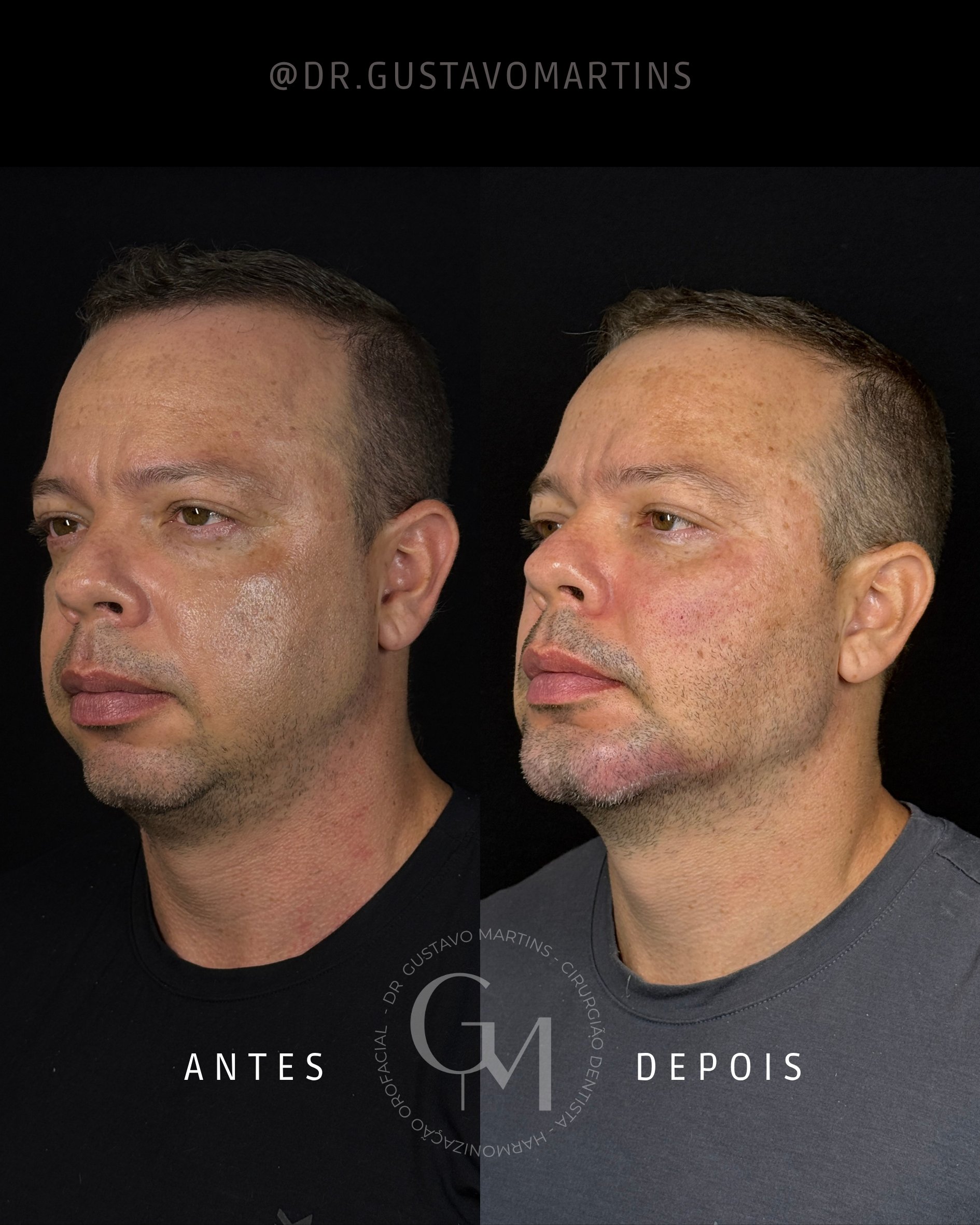 Harmonização Facial · paciente 29