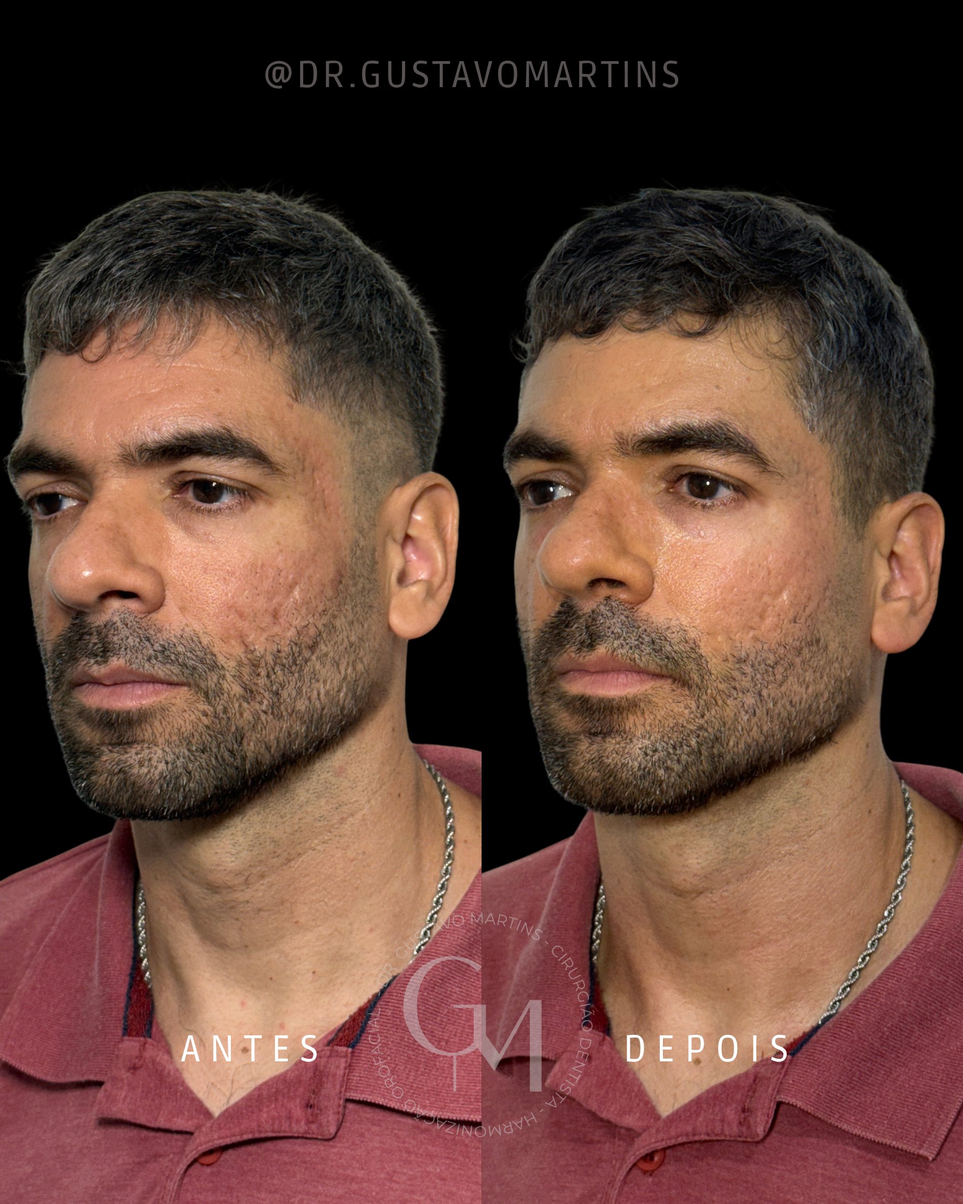 Tratamento de Pele · cicatrizes de acne