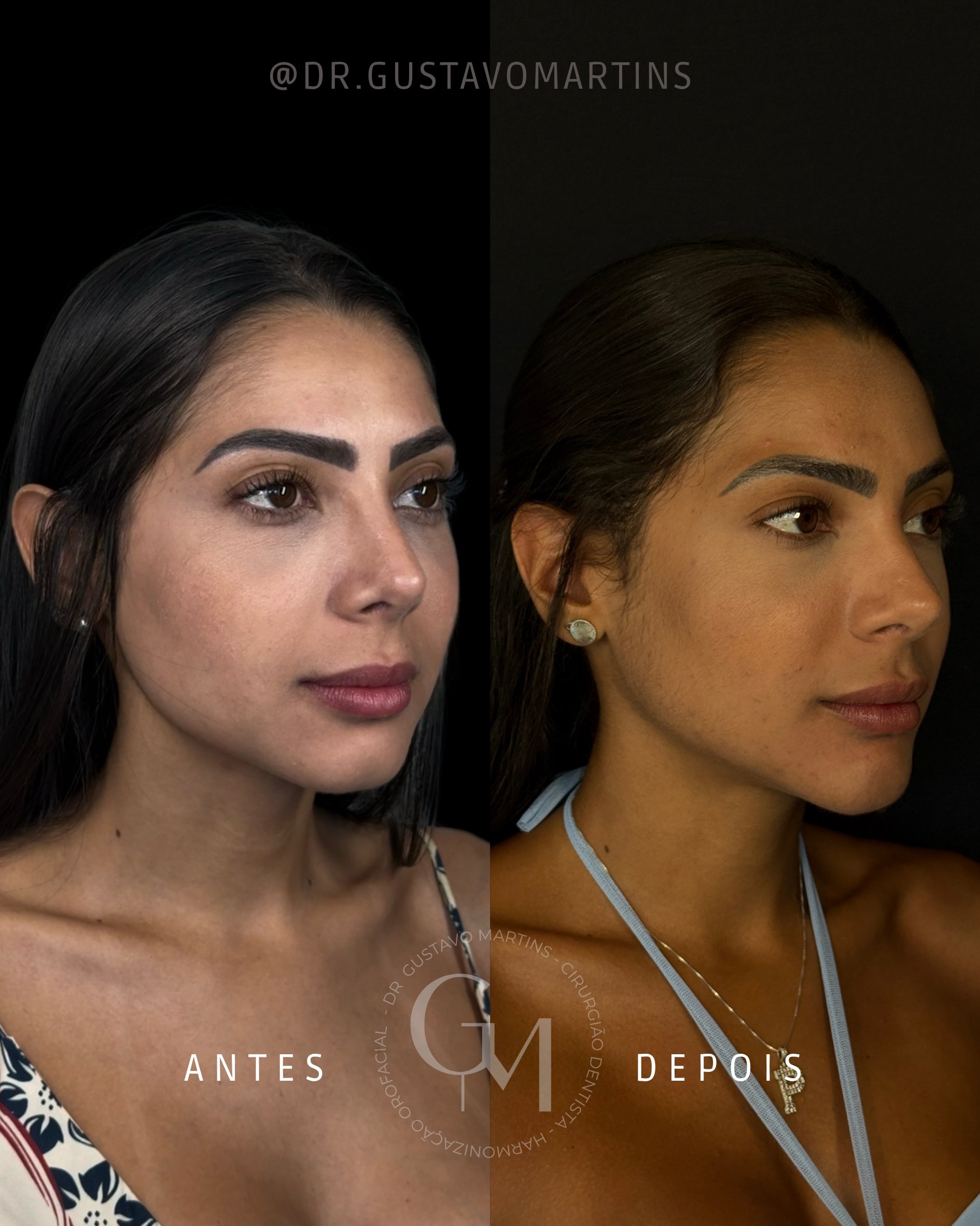 Harmonização Facial · paciente 33
