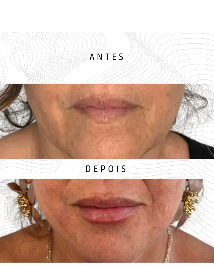 Preenchimento Labial — paciente 2