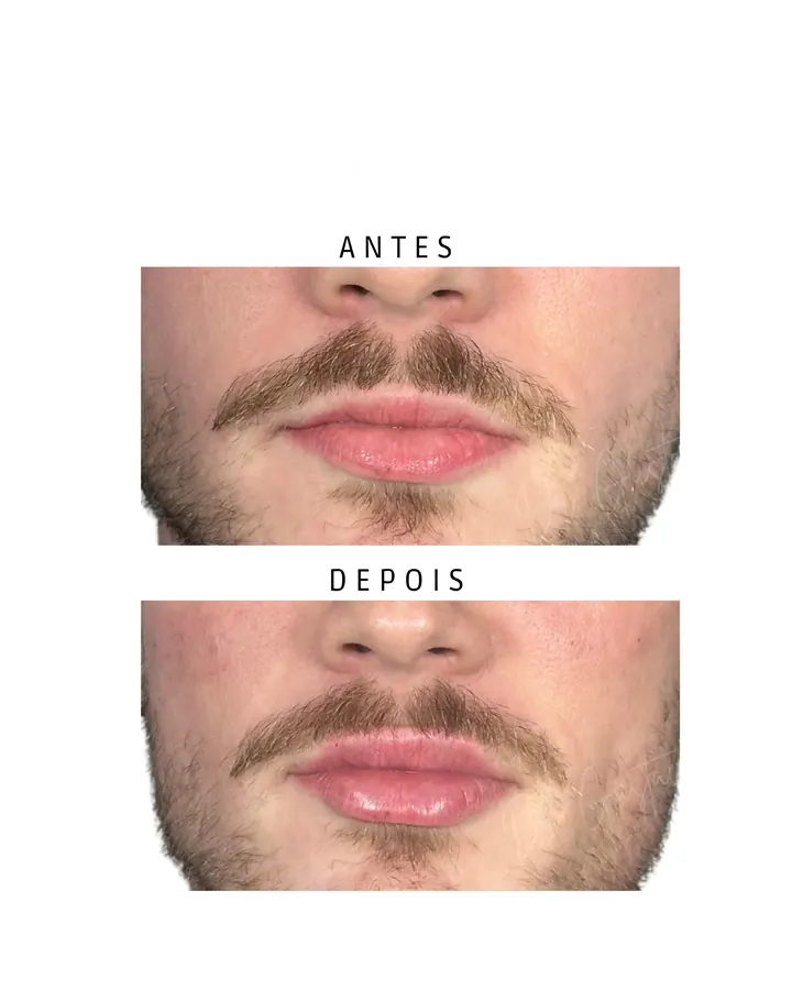 Preenchimento Labial — paciente 3