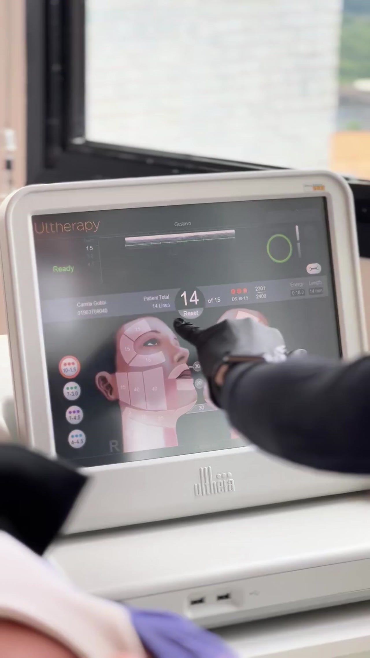 Tela do Ultherapy PRIME mostrando planejamento personalizado do tratamento em tempo real