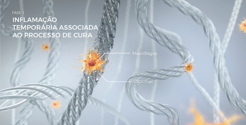 Fase 1 do processo regenerativo do Ultherapy — inflamação temporária com macrófagos e citocinas
