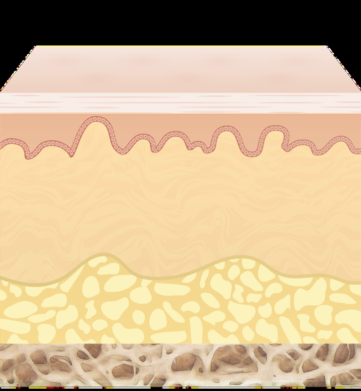 Diagrama das camadas da pele tratadas pelo Ultherapy — 1,5mm, 3,0mm e 4,5mm