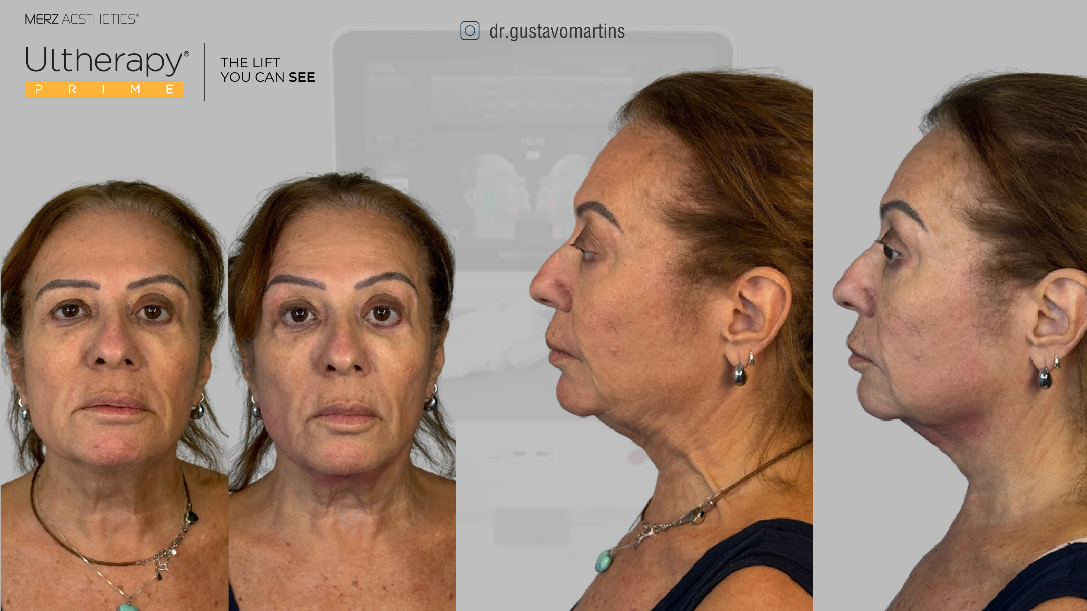 Antes e depois Ultherapy PRIME — frente e perfil — paciente real do Dr. Gustavo Martins