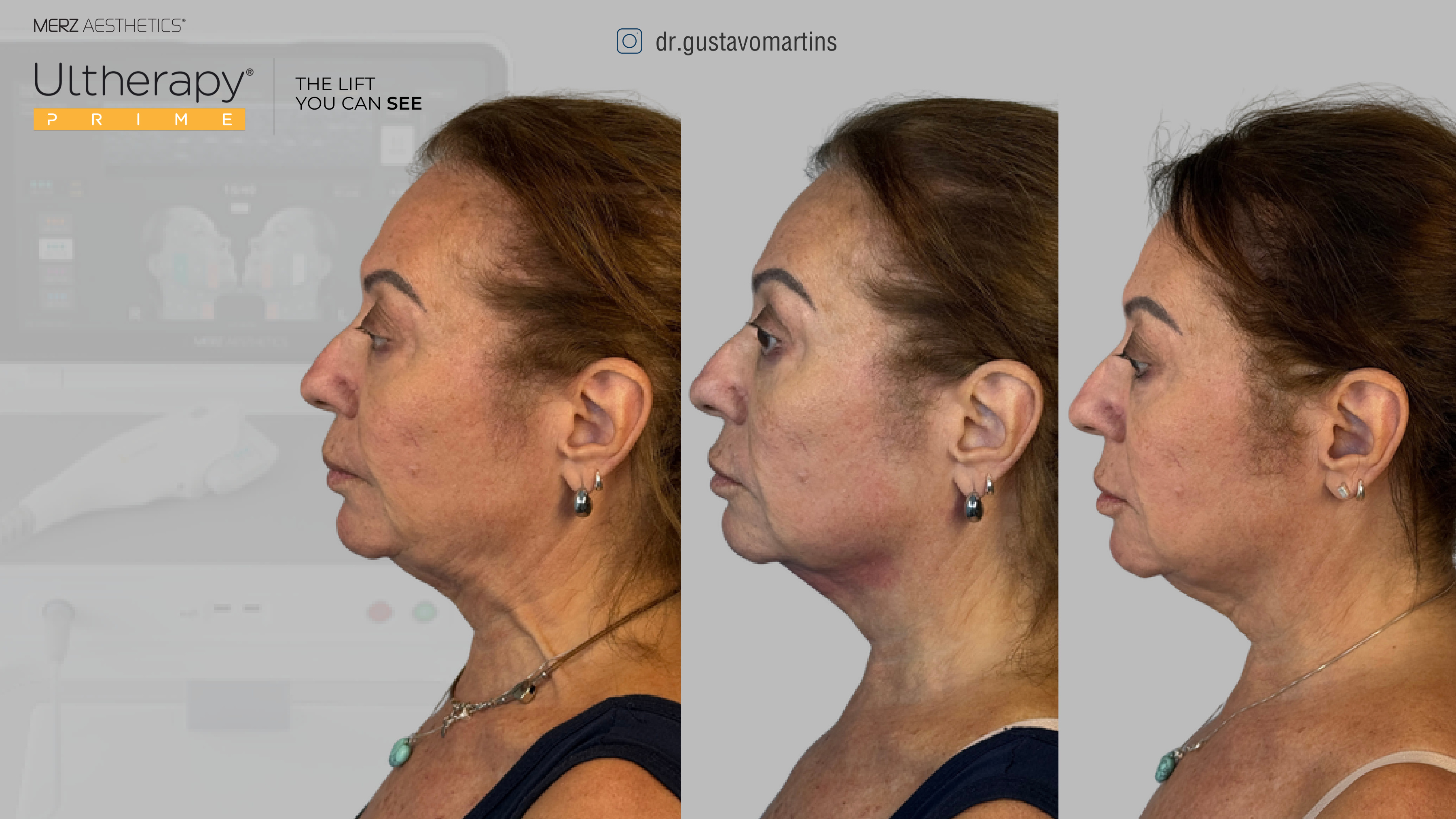 Antes e depois Ultherapy, série de resultado, vista de perfil