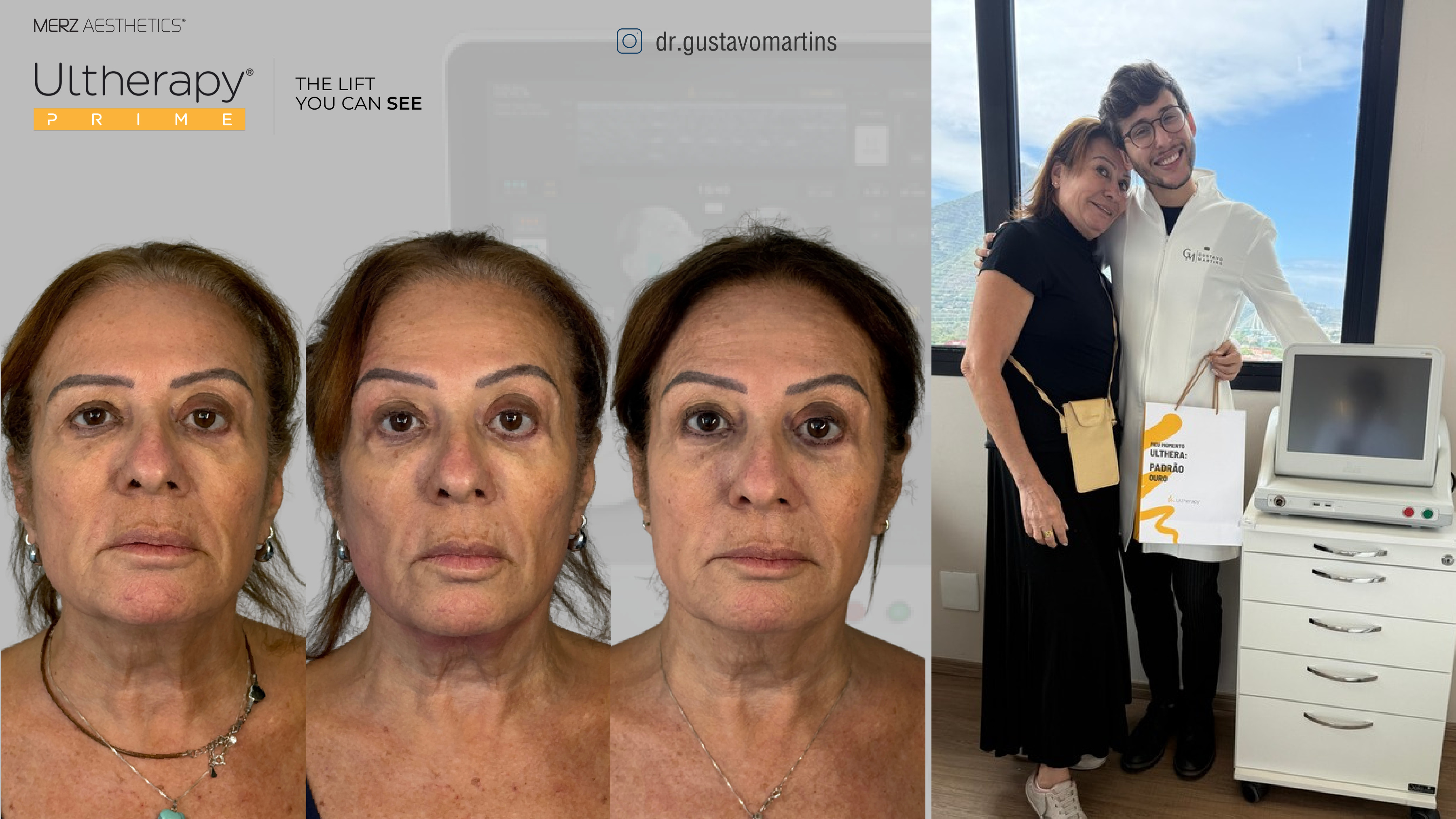 Antes e depois Ultherapy, série de resultado, vista frontal